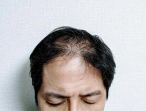 頭頂部が気になり出したら西宮北口メンズカット専門店でご相談ください